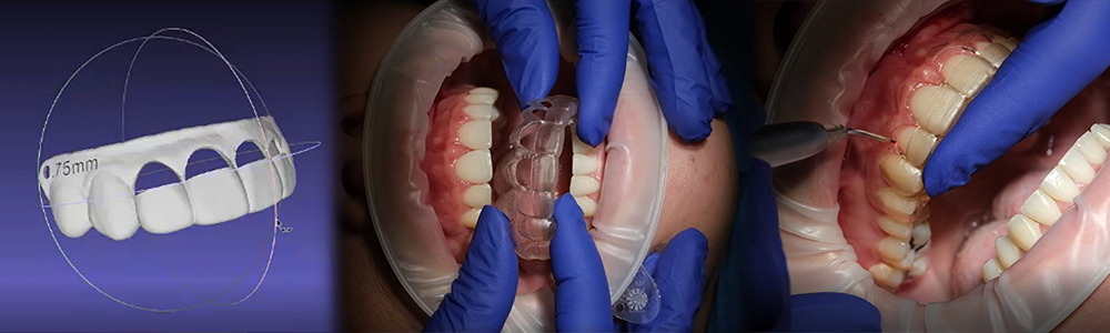 CURSO GINGIVOPLASTIA CURSO GINGIVOPLASTIA